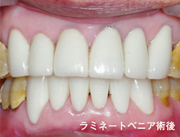 ラミネートベニア4施術後：着色がなくなり白い歯に