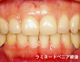 ラミネートベニア1施術後：すき間･がたつきが無くなり白く均一な歯に。