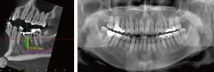歯科用CTスキャン画像1
